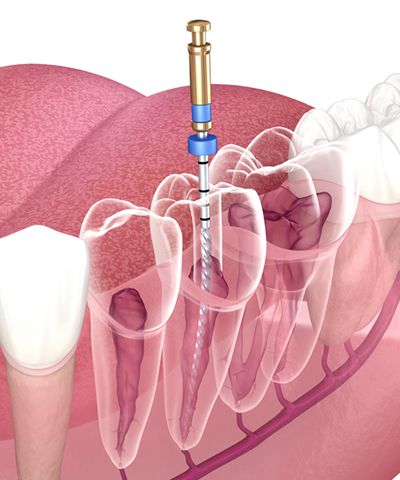 Dental Implants
